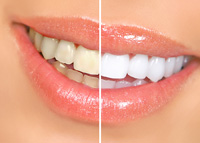 Teeth Whitening | Dentist in Wichita, KS | Lance Anderson DDS 