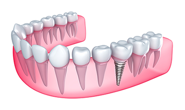 Dental Implants | Dentist in Wichita, KS | Lance Anderson DDS 